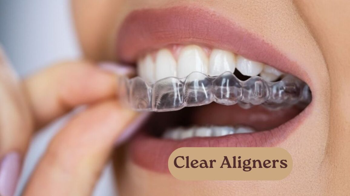 Clear Aligners: The Easiest Way to Straighten Teeth