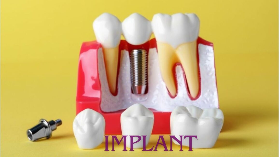 Implant Dentistry: The Most Effective Solution for Missing Teeth