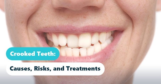Crooked Teeth: Causes, Risks, and Treatments