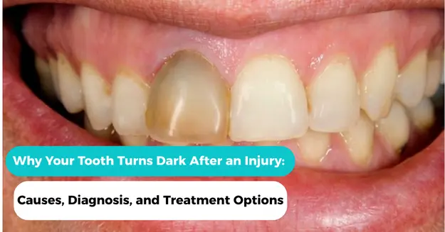Why Your Tooth Turns Dark After an Injury: Causes, Diagnosis, and Treatments